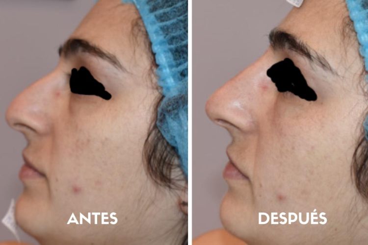 Rusinol-blog-rinomodelacion-antes-y-despues