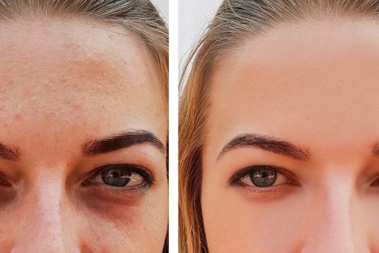 reducir-ojeras-acido-hialuronico